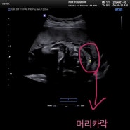 임신 25주 차 특징 및 증상 : 임당검사, 정밀초음파