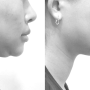 턱끝 전진 (6) -턱끝 전진은 단지 턱끝이 앞으로 나오는 것이 아닌, 입체적이고 팽팽한 얼굴선을 위한 수술.