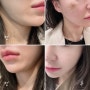 30대 여자 얼굴 실리프팅 한 달 후기 (효과, 부작용)