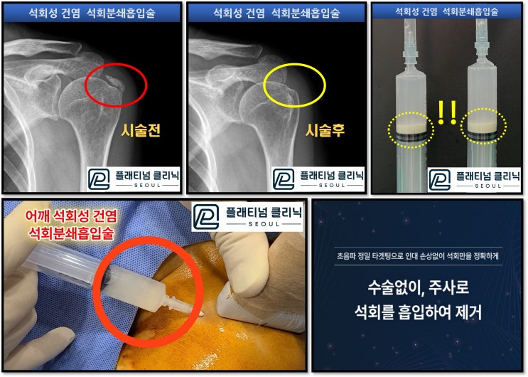 어깨 석회성 건염 치료는 어디서? 강남 신사역 정형외과 플래티넘의원에서. 석회분쇄흡입술 명의.