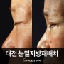 대전 눈밑지방재배치 수술 전/후 차이