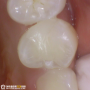 거여동 치과 치아 사이 충치 인레이를 통한 증상 개선 과정