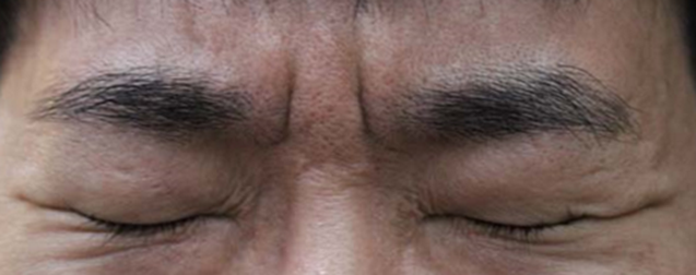 미간주름 영구교정사례분석, 눈썹내절개선. 1개월, 2개월, 3개월 : 네이버 블로그
