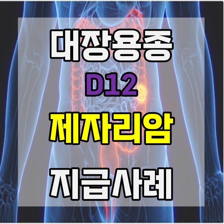 대장용종절제술(polypectomy) 후 결장 선종(D12) 제자리암 진단비 지급사례 : 네이버 블로그