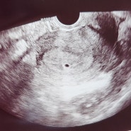 새댁 끝 임신 시작 (임신 극초기 증상)