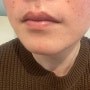 신용산 피부과 : 콧수염 인중 턱수염 레이저 제모 3번 예약한 후기