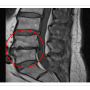 척추관 협착증(Spinal stenosis) 정의와 특징