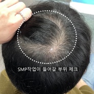 정수리가 깔끔해진 느낌? SMP 받으면서 탈모스트레스 해결 / 울산새김