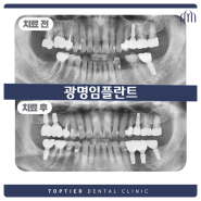 광명임플란트 면밀한 진단을 토대로