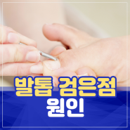 발톱 검은점 원인 건강에 이상 있는 걸까