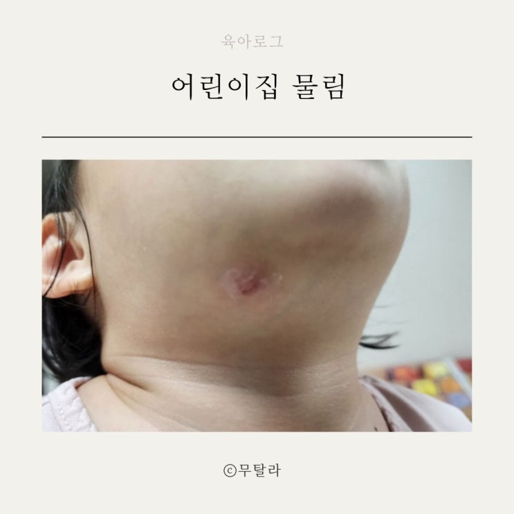 어린이집 물림 사고 대처 경험담 공유 만1세반 : 네이버 블로그