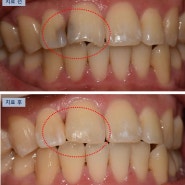 앞니 사이 충치 레진 치료 [월곡역 치과 서울바른닥터치과]