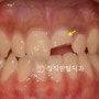 분당 정자동치과) 부러진 앞니 붙이기, 앞니 외상 레진 치료
