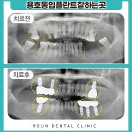 용호동임플란트잘하는곳 양측으로 임플란트를