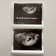 신장이식 임신 초기 7~10주 차 기록! (검사 기록 공유)