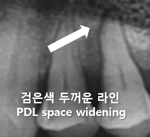 PDL space widening 몰랐다면 지금 알면됩니다. (클릭안하면 손해) : 네이버 블로그