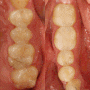 충치치료 후 안양역 치과 에서의 정기검진을 통한 꾸준한 관리
