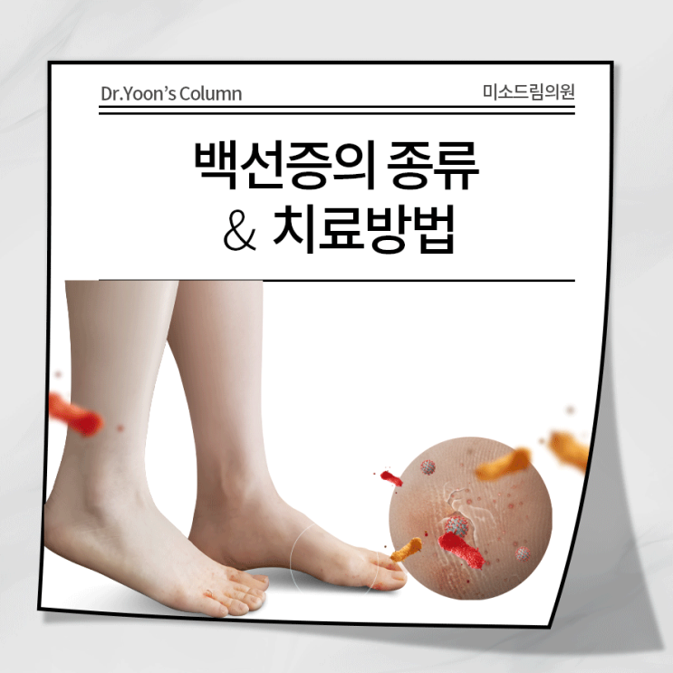 성남피부과추천 백선증이란? 백선증의 종류(체부백선, 두부백선, 조갑백선 등)와 원인, 치료법 : 네이버 블로그