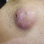 [Dr.ParK] 얼굴에 발생한 염증성 표피 낭종 제거 수술