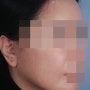 [유캔비성형외과] 안면거상 1개월 경과