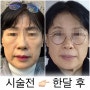 압구정 온다리프팅 효과 ,가격, 5만줄