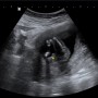 둘째 임신 16주 2차 기형아검사 + 성별확인