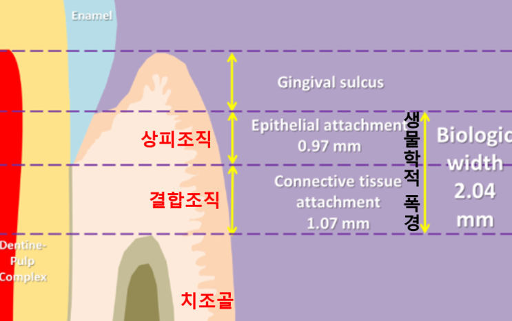 Biologic width / Ferrule effect 아니 김선생 이것도 알아? (당장클릭) : 네이버 블로그