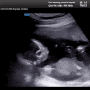 임신일기8 ::: 16주차, 2차 기형아검사, 소뇌 확인