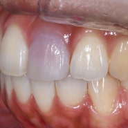 앞니부딪힘 후 치아변색 : 앞니금/앞니깨짐 및 부러짐, 치아뿌리 금가서 발치 진단 할 수 밖에 없는 상황