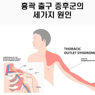 흉곽출구 증후군 Thoracic Outlet Syndrome(TOS) 팔 저림원인 증상과 해결방법