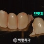 오래된 임플란트 브릿지 파절 과 드러난 마진 으로 인한 재 보철물 제작 (당일 임시치아 가능) 고척동 치과
