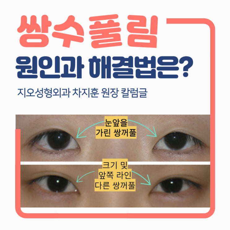 [칼럼] 쌍꺼풀 수술 후 풀림 현상...그 원인과 해결법은? : 네이버 블로그