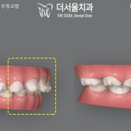 인비절라인 퍼스트 통해 악궁 확장 및 2급 부정교합 해소 후 치아 공간 확보 하여 가지런한 영구치 맹출 유도 분당 치과