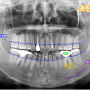 월성동 치과 임플란트 잇몸 염증은 치조골을 소실시키게 됩니다. (뼈이식을 받아야 될 수 있습니다.)