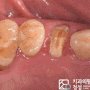 자연치 파절 및 뿌리 염증 금정역 치과 에서 임플란트 로 빠르게 문제 해결