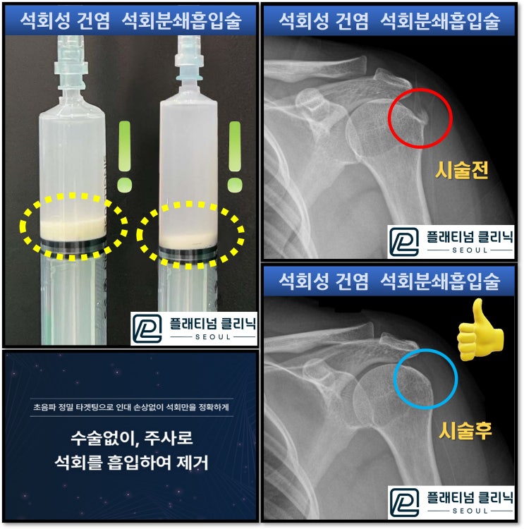 어깨 석회성 건염 수술해야 하나? 수술없이 치료된다면? 강남 신사역 정형외과 플래티넘의원에서 딱!!