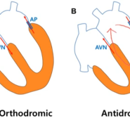 20. 정방향 역방향 방실회귀빈맥 orthodromic antidromic AVRT