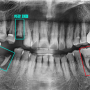 산본역 치과 발치 즉시 임플란트 를 통한 빠른 회복 케이스(3개월간의 과정 기록)