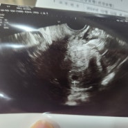 [자궁선근증자연임신] 10주차, 입덧과의 싸움