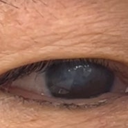 눈높이안과: 각막타투(각막문신) 사례 (경기 군포 60대 환자)