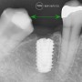 비산동 치과 는 쓰러진 치아 사이로 임플란트를 심을 수 있을까?