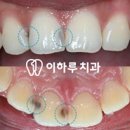 신촌 이하루 치과 앞니 치아 사이 충치 레진 충전 이맥스 인레이 수복, 20대 스케일링 잇몸치료 흡연