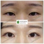 중등도의 안검하수로 절개법 쌍꺼풀 수술 눈매교정을 시행한 30대 여성(신논현 이와백)
