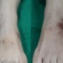[발등 색소침착, 발목 흉터] 다리 레이저 치료 경과 : 마곡 발산 여의사 피부과
