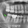금이 간 치아를 방치하면 안돼요! 성남치과 더서울치과의 치근 파절 치료 사례