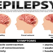 뇌전증 간질 원인과 증상을 개선하는 영양제는?