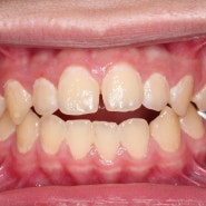 [동탄교정] 교정 치료시 치아는 어떤 원리로 움직일까요??