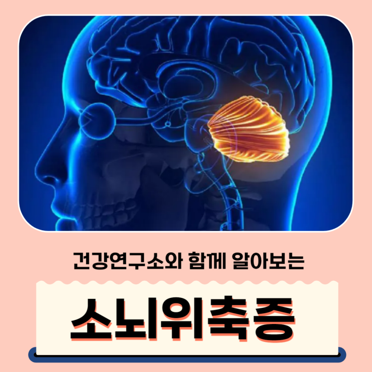 소뇌 위축증초기증상 유전 치료 : 네이버 블로그