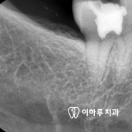 이대 치과 충치 확인 생겼을 때 이유 치수절단술, Pulpotomy