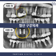 철산 구강외과, 어려운 케이스라도 문제없는